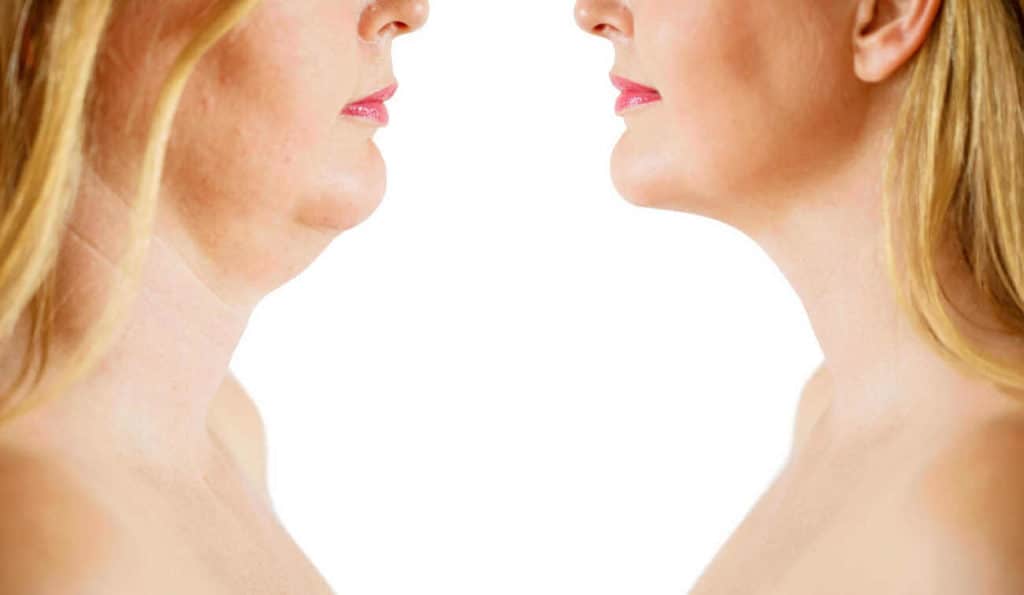 Double Chin treatment Tyne & Wear before and after results