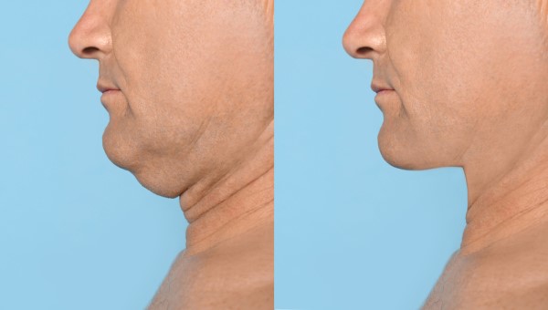 Which Non-Surgical Treatments Work Best for Jowls and Loose Skin Tyne & Wear?
