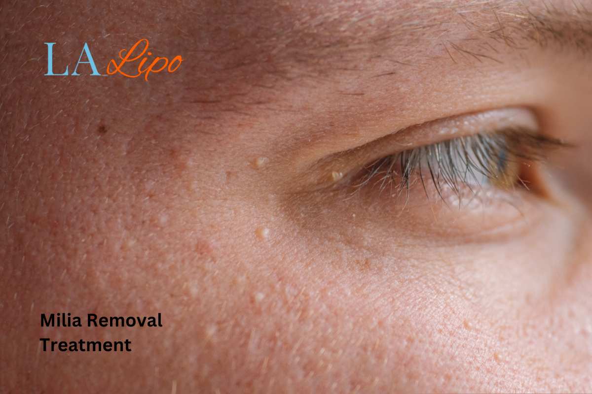Cryopen Milia Removal: Is It the Easiest and Safest Option Tyne & Wear?