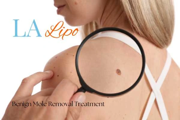 Woman having her inspection of blemish before mole removal Tyne & Wear