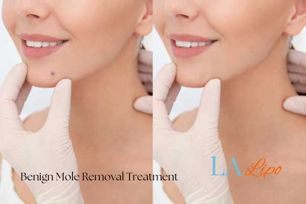 woman's before and after mole removal Tyne & Wear results