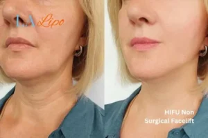 hi-fu for wrinkles Tyne & Wear before and after results