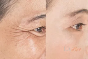 Before and after results of woman - HI-fu wrinkles reduction treatment Tyne & Wear