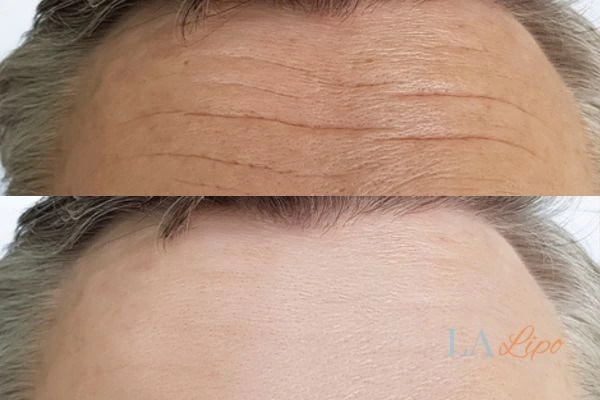 results of HIFU Tyne & Wear on mans forehead to help reduce lines and wrinkles