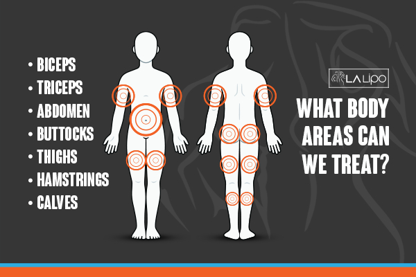 Graphic to show areas you can have LA-EMS Body Sculpting Tyne & Wear treatment.