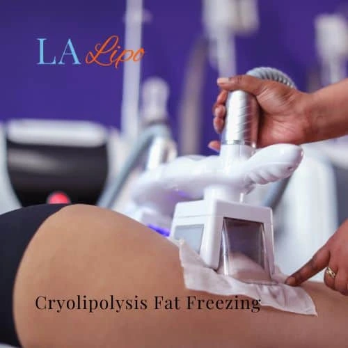 fat freezing - Cryolipolysis Tyne & Wear