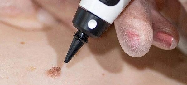 skin tag removal using cryopen Tyne & Wear