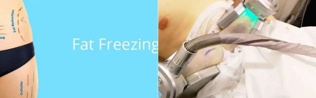 Fat freezing Tyne & Wear on multiple areas of the body