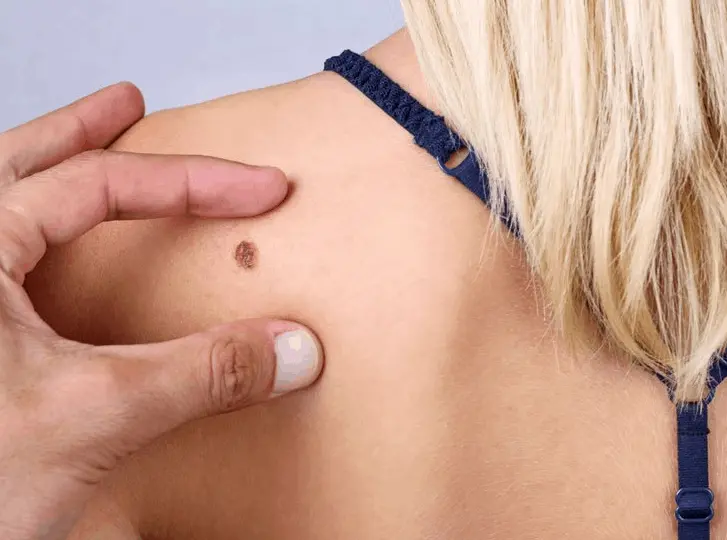 woman having mole removal Tyne & Wear consultation before treatment.