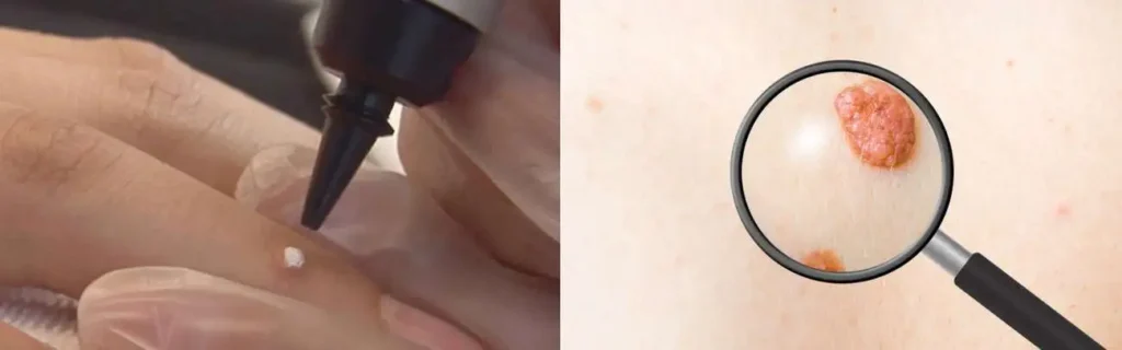 Cryopen for mole removal Tyne & Wear - speak to our team today!