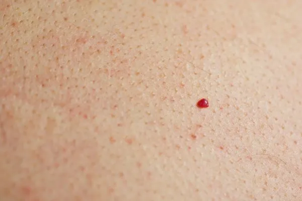 close up of a cherry angioma Tyne & Wear