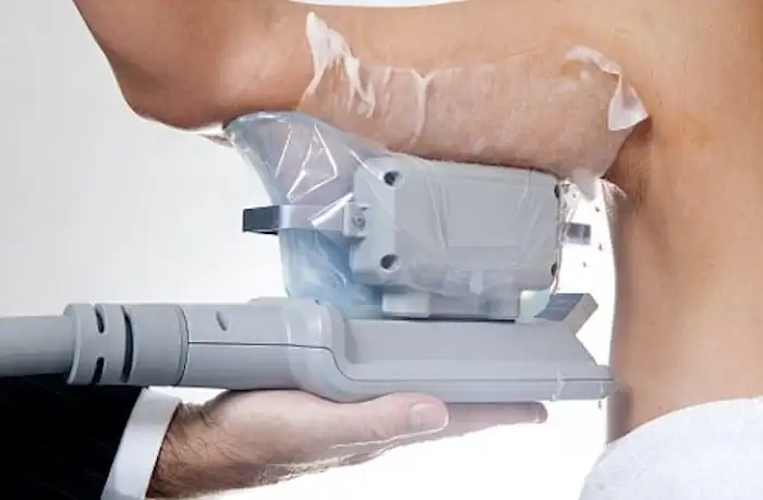 Picture of fat freezing Tyne & Wear on the upper arms.