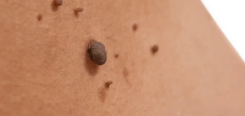 image of a skin tag Tyne & Wear