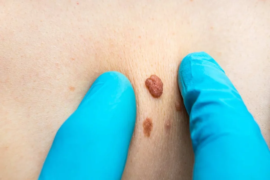 Consultant examining a skin tag Tyne & Wear