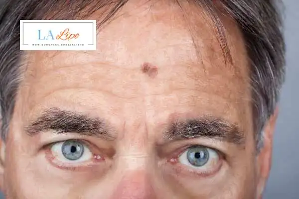 Solar Lentigo Removal Tyne & Wear image of man with mark on his forehead