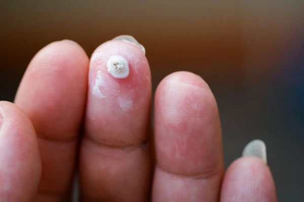 wart on person finger - cryotherapy to treat from LA LIPO Tyne & Wear