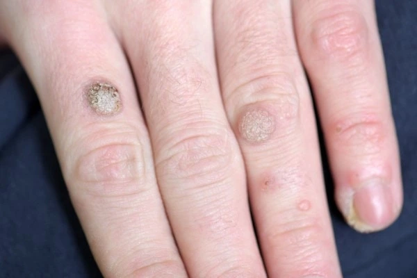 photo of warts on person hand - see wart removal Tyne & Wear from LA LIPO