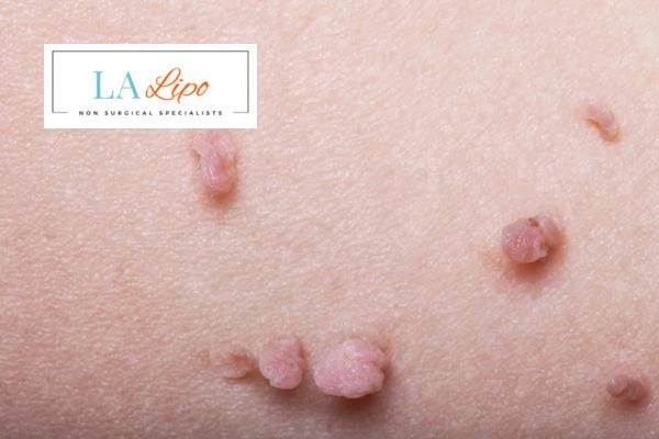 Does cryopen skin tag removal Tyne & Wear hurt? Find out now call our team today!