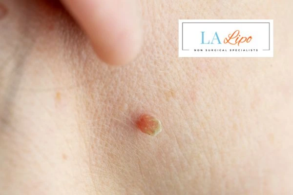 Book skin tag removal Tyne & Wear today speak to our team now!