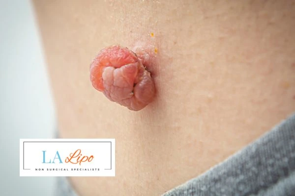 Interested in skin tag removal Tyne & Wear? Concerned about the pain? Find out more today!