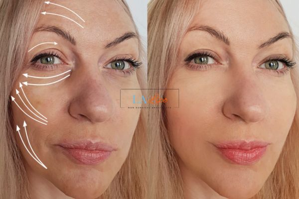 Morpheus 8 results Tyne & Wear face lift.