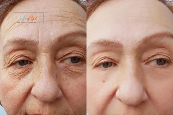 The powerful benefits of Morpheus8 Treatment Tyne & Wear - Call Our team today!