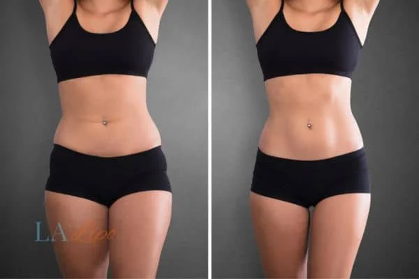 before and after results of non-surgical treatment to help a woman's body image and mental health Tyne & Wear