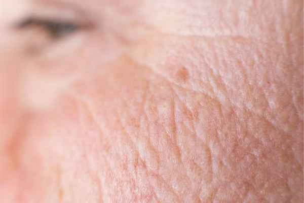 close up picture of a woman's face showing an age spot Tyne & Wear