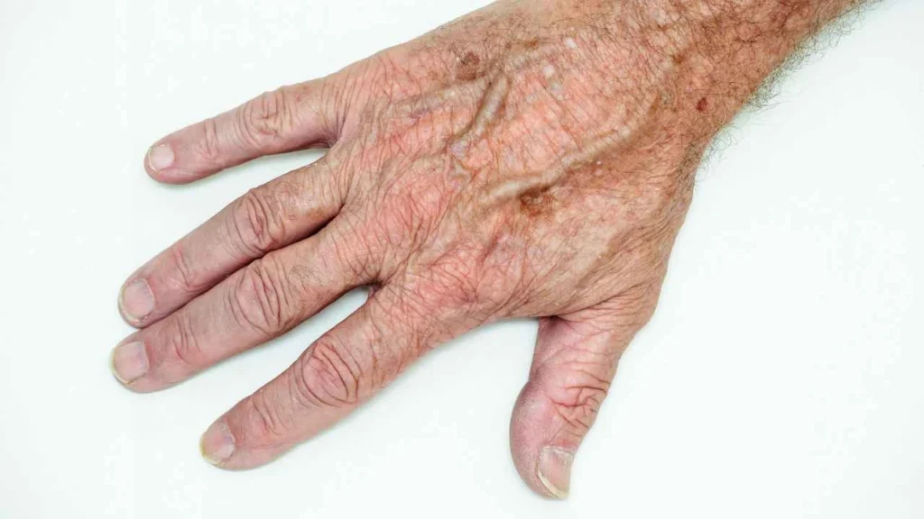 Male hand showing age spot Tyne & Wear