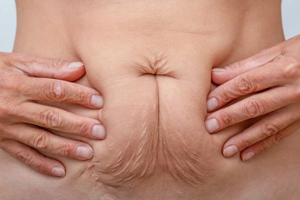 Image of a woman's stomach with loose skin - example of skin tightening Tyne & Wear options