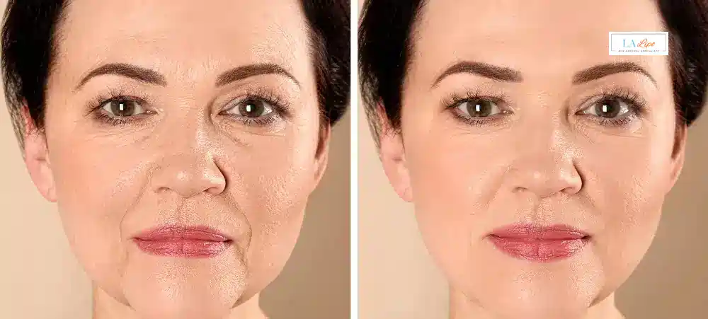 How Long Does It Take to See Results and How Long Do They Last Tyne & Wear?