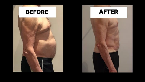 What Symptoms Can Diastasis Recti Cause in Men? Weak Core, Back Pain and Poor Posture Tyne & Wear